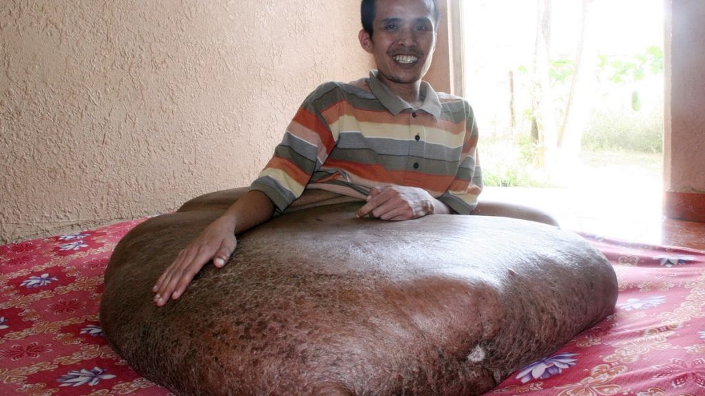 Der krebskranke Vietnamese Nguyen Duy Hai sitzt am 15.06.2011 in seinem Haus in Da Lat (Vietnam) und zeigt seinen Tumor. (Foto)