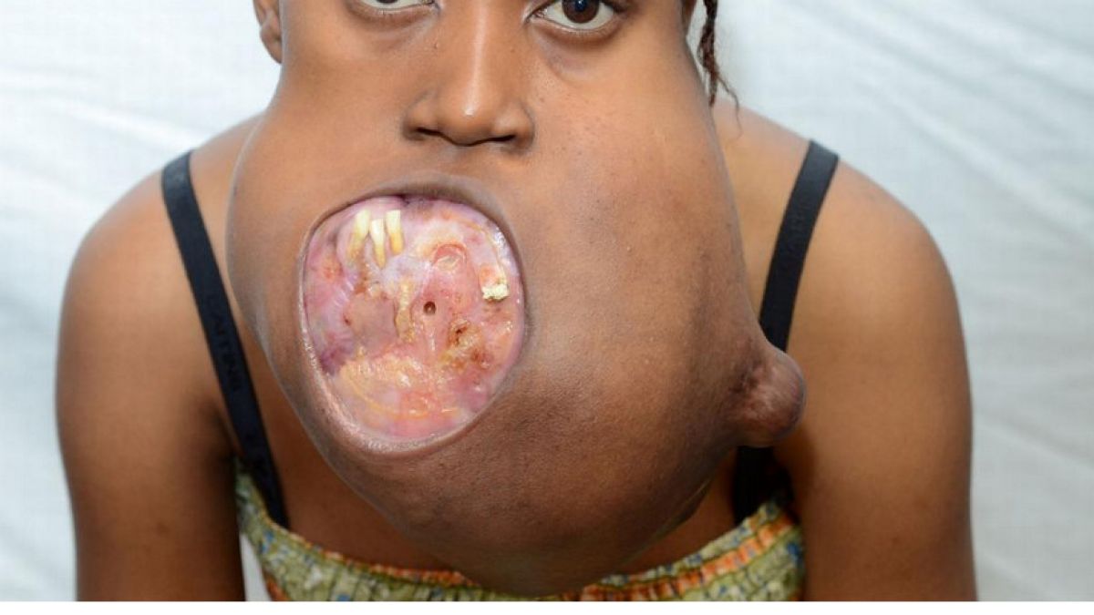 Die 17-jährige Grace wurde von einem monströsen Tumor im Gesicht entstellt, bevor Ärzte sich ihrer annahmen. (Foto)
