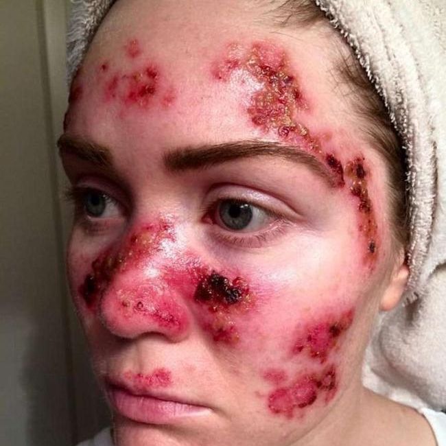 Junge Mutter schockt mit Hautkrebs-Selfie!