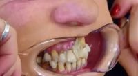 Die Zähne dieser Britin sind völlig verwahrlost.