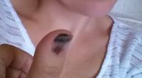 Melanie Williams zeigt auf diesem Facebook-Foto den dunklen Fleck unter ihrem Daumennagel: Kein Nagelpilz, sondern Krebs.