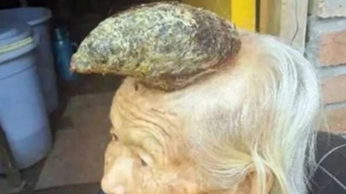 Chinesin (87) lebt mit Horn auf dem Kopf. (Foto)