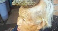 Chinesin (87) lebt mit Horn auf dem Kopf.