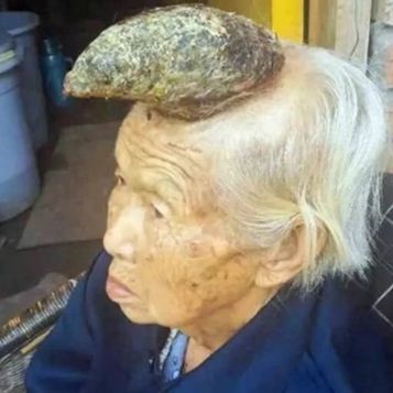 Chinesin (87) wächst ein Horn aus dem Kopf!