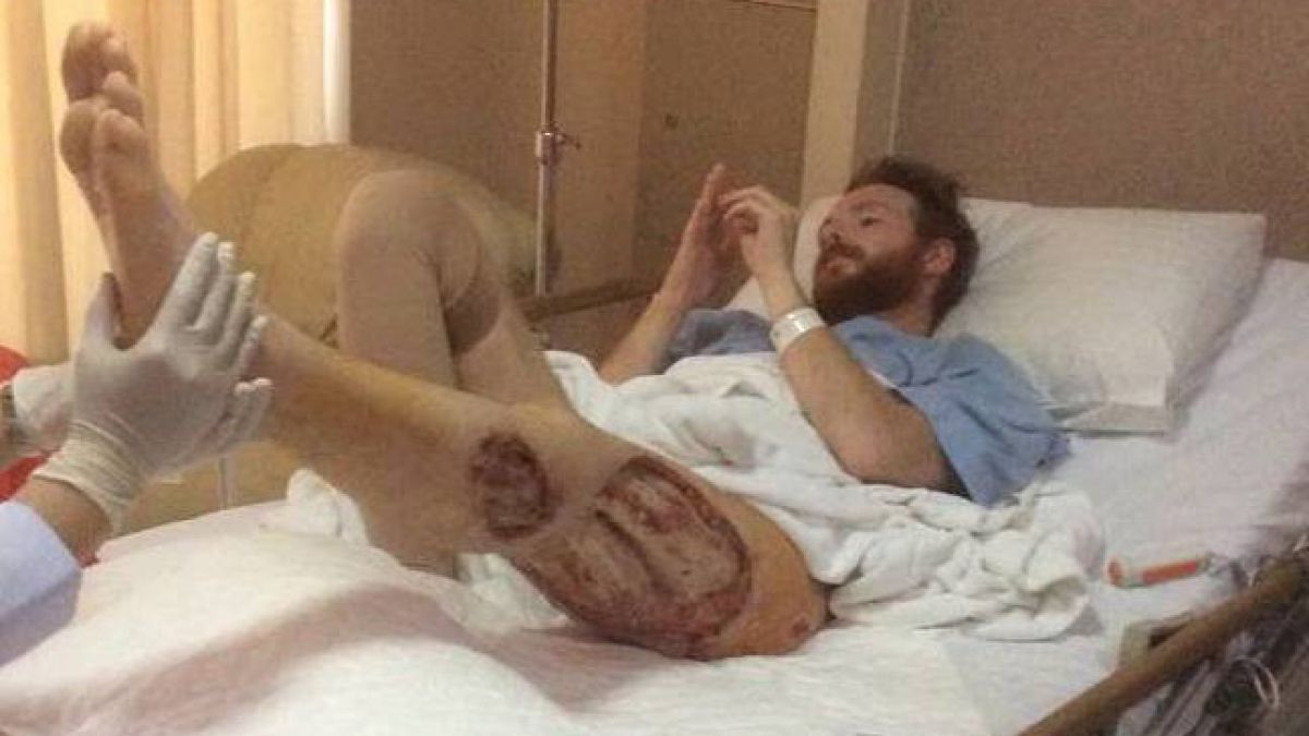 Das Bein von Ben Whiteside wurde von Bakterien zerfressen! (Foto)