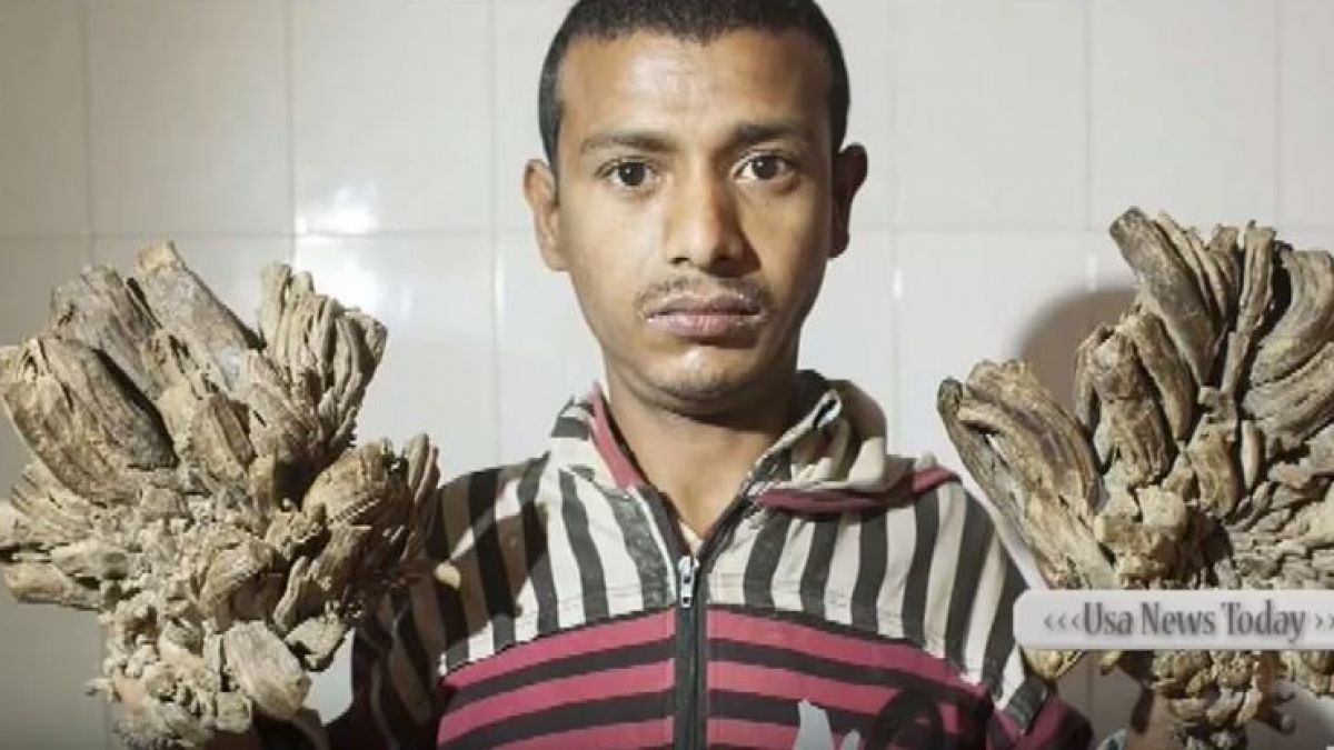 Ein junger Mann mit der "Baum-Mann-Krankheit" soll in Bangladesch operiert werden. (Foto)