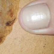 Ein australisches Mädchen hustete diesen Parasiten aus.