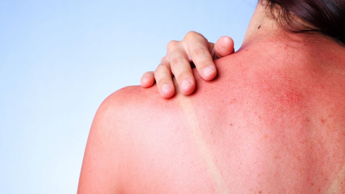 Sonnenbrand tut nicht nur weh, sondern erhöht auch das Risiko für Hautkrebs. (Foto)