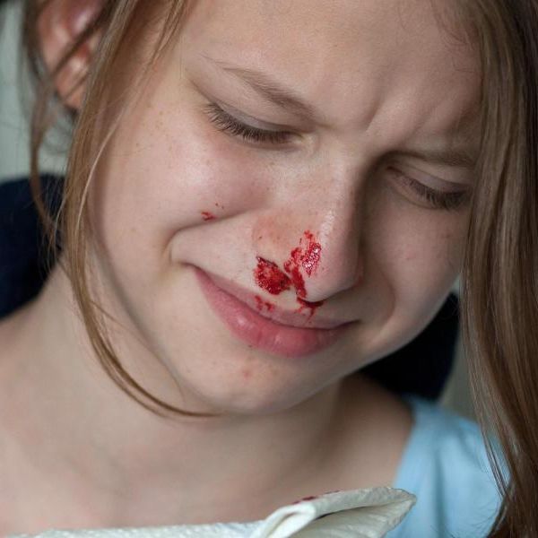 Was tun, wenn die Nase blutet? Was tun, wenn die Nase blutet? (Foto)