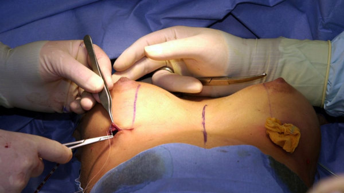 Eine 24-jährige Engländerin muss sich nach einer Brust-OP nun die Brustwarzen komplett entfernen lassen. (Symbolbild) (Foto)