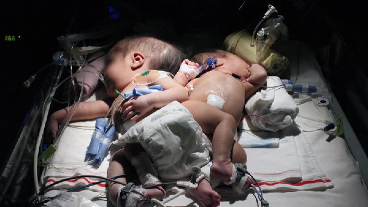 Die Siamesichen Zwillinge wurden direkt nach der Geburt von ihrer Mutter getrennt. (Foto)