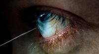 Bei der transorbitalen Lobotomie wird ein dünner Eispickel am Auge vorbei ins Gehirn eingeführt. Durch rhythmische Bewegen sollen falsch verknüpfte Nervenbahnen getrennt werden.