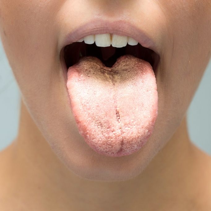 DAS verrät die Zunge über Ihre Gesundheit