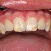 Zähne durch drogen schlechte Zahnarzt warnt