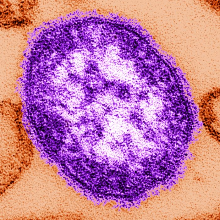 Dramatischer Masern-Anstieg! Droht jetzt eine Epidemie? Dramatischer Masern-Anstieg! Droht jetzt eine Epidemie? (Foto)