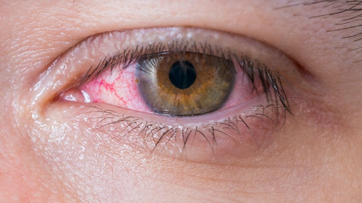 In Indien mussten Ärzte einen 15-Zentimeter-Parasiten aus dem Auge eines Mannes entfernen (Symbolbild). (Foto)