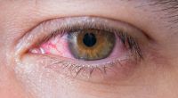 In Indien mussten Ärzte einen 15-Zentimeter-Parasiten aus dem Auge eines Mannes entfernen (Symbolbild).
