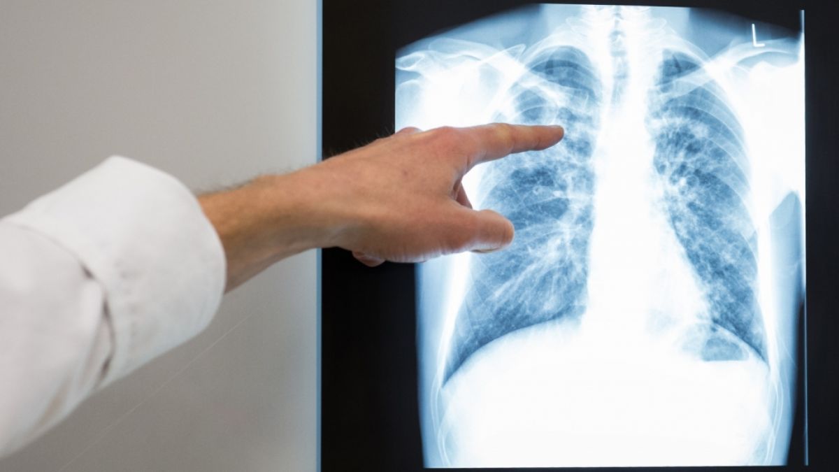 In Kalifornien hat sich ein Mann wortwörtlich die Lunge aus dem Leib gehustet. (Symbolfoto) (Foto)