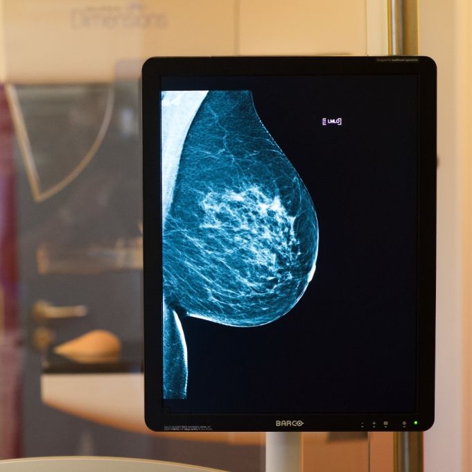 Neuer Bluttest erkennt zuverlässig Brustkrebs Neuer Bluttest erkennt zuverlässig Brustkrebs (Foto)