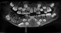 Ein sieben Jahre alter Junge aus Indien hatte 526 Zähne im Mund, wie ein Röntgenbild beweist.