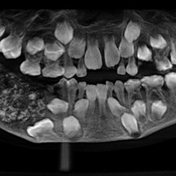 Unglaublich! Zahnärzte operieren 526 Zähne aus Kindermund