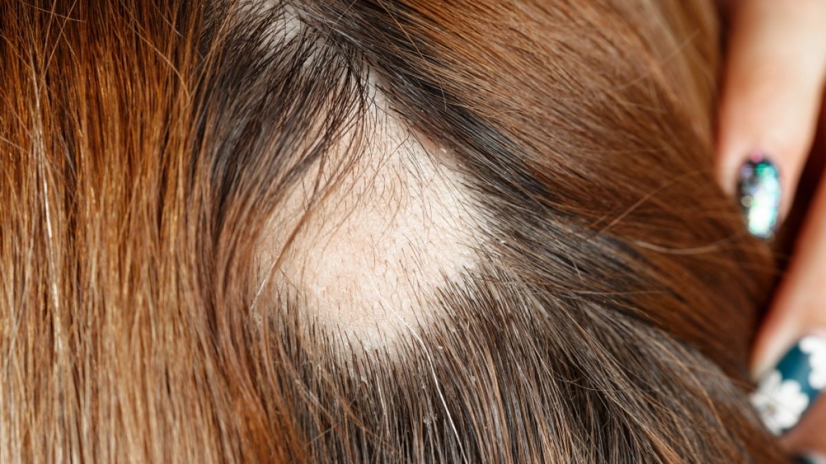 In Deutschland leiden rund 1,5 Millionen Menschen an kreisrundem Haarausfall, auch Alopecia areata genannt. (Foto)