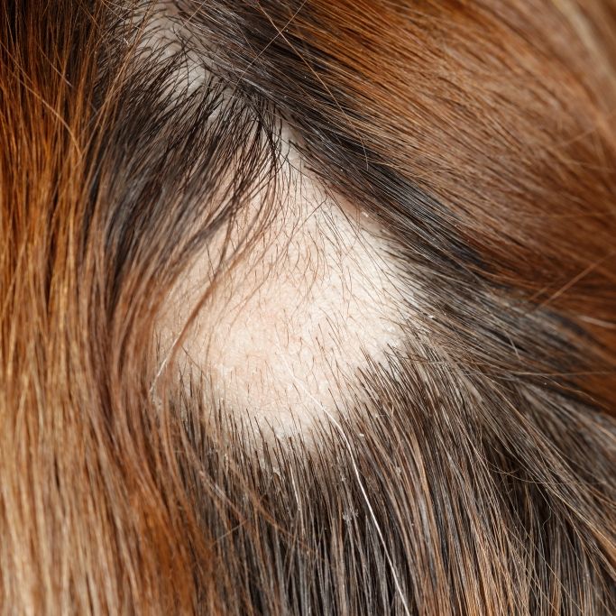 Wie entsteht kreisrunder Haarausfall - und welche Therapie hilft?