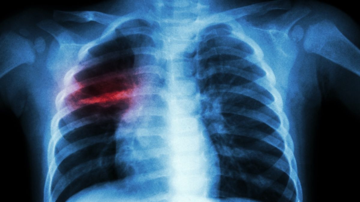Röntgenbilder zeigen, wie sehr das Coronavirus den Lungen schädigt. (Symbolbild) (Foto)