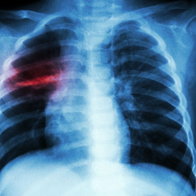 Zerstörte Lunge! Schock-Fotos von Corona-Patienten veröffentlicht