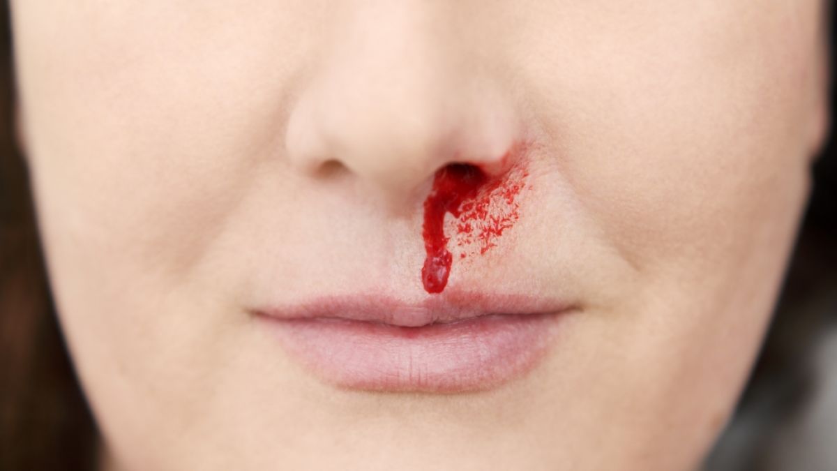 Eine Frau hatte Nasenbluten. Wenig später verlor sie ihr Gedächtnis. (Symbolfoto) (Foto)