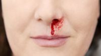 Eine Frau hatte Nasenbluten. Wenig später verlor sie ihr Gedächtnis. (Symbolfoto)
