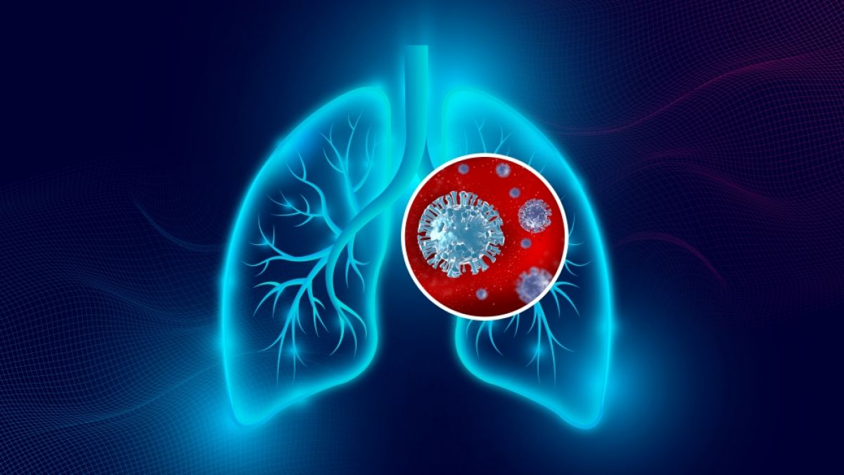 Auch bei milden Covid-19-Krankheitsverläufen sind offenbar Schädigungen der Lunge möglich. (Foto)