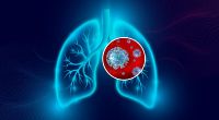 Auch bei milden Covid-19-Krankheitsverläufen sind offenbar Schädigungen der Lunge möglich.