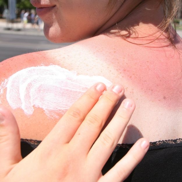 Sonnenbrand-Alarm durch UV-Strahlung! DIESER Trick rettet Ihre Haut