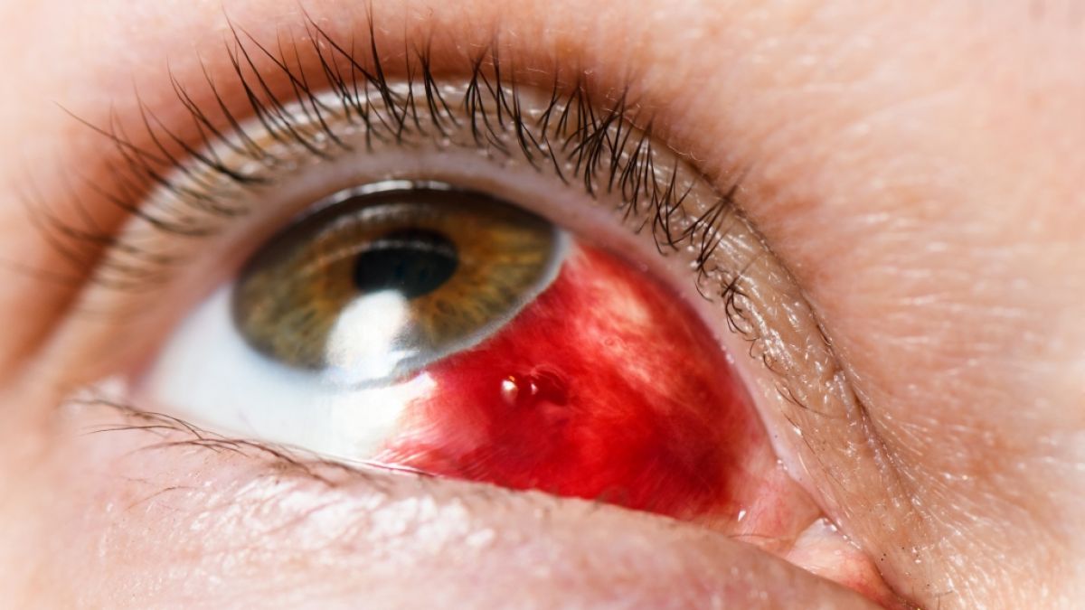 UV-Strahlung schadet dem Auge: So schützen Sie ihr Augenlicht. (Foto)