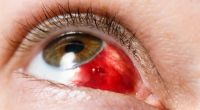 UV-Strahlung schadet dem Auge: So schützen Sie ihr Augenlicht.