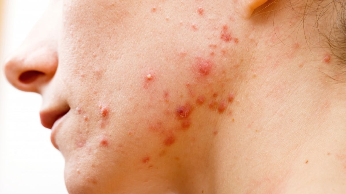 Hautprobleme wie Akne sind bei Jugendlichen keine Seltenheit - doch bei der medikamentösen Behandlung ist Vorsicht geboten (Symbolbild). (Foto)