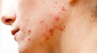 Hautprobleme wie Akne sind bei Jugendlichen keine Seltenheit - doch bei der medikamentösen Behandlung ist Vorsicht geboten (Symbolbild).
