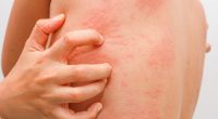 Einer spanischen Studie zufolge könnten Hautveränderungen noch vor dem Ausbruch klassischer Symptome auf eine Coronavirus-Infektion hinweisen (Symbolbild).
