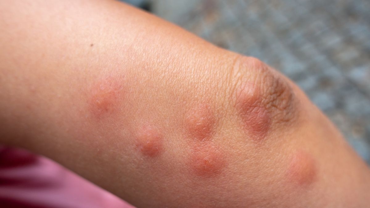 In Australien häufen sich die Erkrankungen mit der bakteriellen Infektionserkrankung Buruli Ulcus. (Symbolfoto) (Foto)