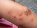 In Australien häufen sich die Erkrankungen mit der bakteriellen Infektionserkrankung Buruli Ulcus. (Symbolfoto) (Foto)