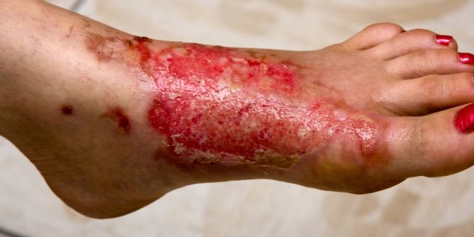 Toxische epidermale Nekrose