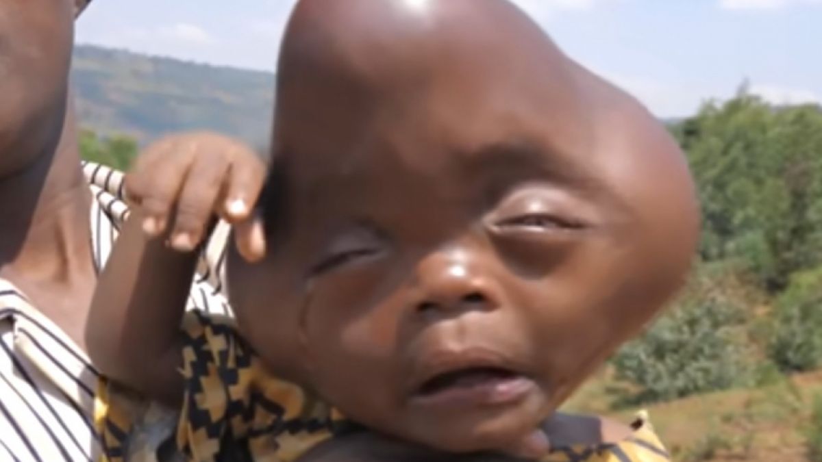 Das Kind von Bajeneza Liberata kam mit einem deformierten Kopf zur Welt. (Foto)