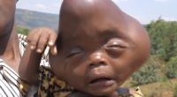 Das Kind von Bajeneza Liberata kam mit einem deformierten Kopf zur Welt.