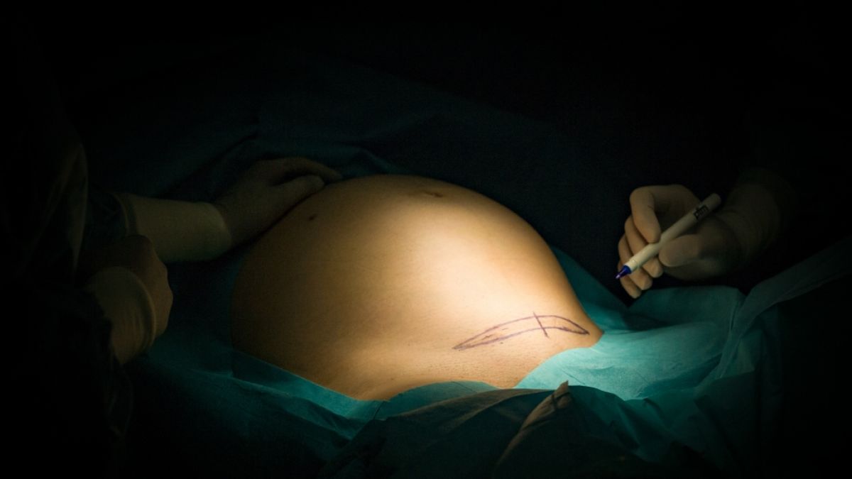Bei einem Kaiserschnitt wurde ein Bauchtuch im Körper einer Frau vergessen. (Foto)