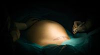 Bei einem Kaiserschnitt wurde ein Bauchtuch im Körper einer Frau vergessen.