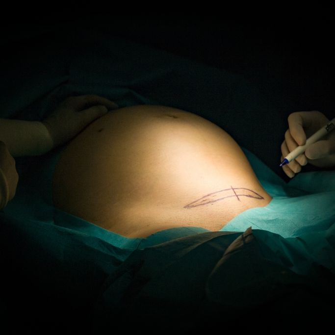 OP-Tuch bei Kaiserschnitt im Bauch vergessen! Frau klagt über extreme Schmerzen