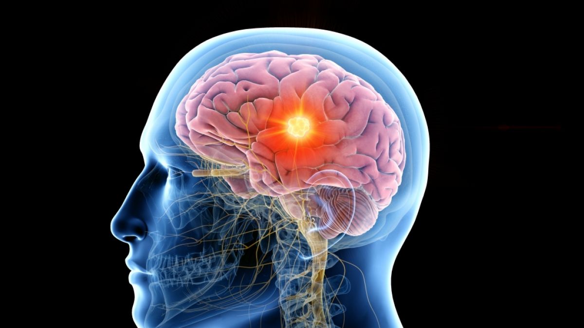 Ein 35-jähriger Mann hat eine Schimmel-Wucherung in seinem Gehirn. (Symbolfoto) (Foto)