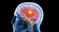 Ein 35-jähriger Mann hat eine Schimmel-Wucherung in seinem Gehirn. (Symbolfoto)