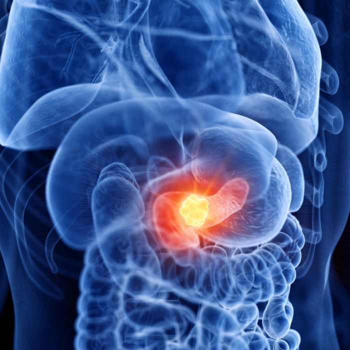 Krebs-Sensation! Pankreaskrebs durch Stuhlprobe entdeckt